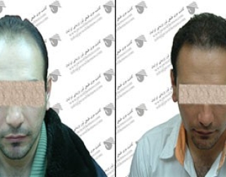 کاشت مو کهنمویی در اصفهان
