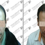 کاشت مو کهنمویی در اصفهان