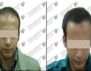 کاشت مو دکتر حميدرضا کهنمویی در اصفهان