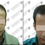 کاشت مو دکتر حميدرضا کهنمویی در اصفهان