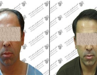 کاشت مو دکتر حميدرضا کهنمویی در اصفهان