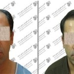 کاشت مو در کلینیک کهنمویی