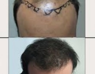 دکتر مسلمی کاشت موی طبیعی