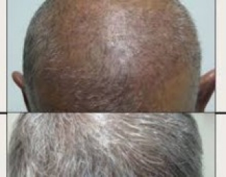 کاشت مو طبیعی اصفهان مسلمی