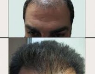 کلینیک دکتر مسلمی کاشت مو