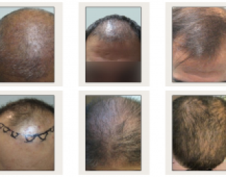 کاشت مو دکتر مسلمی