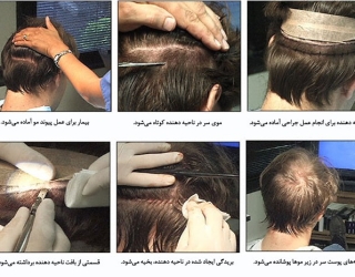 کاشت مو در کلینیک شریعتی اصفهان