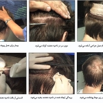 شریعتی کاشت مو