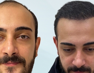 کلینیک کاشت مو باران در اصفهان
