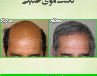 کلینیک کاشت مو طبیعی دکتر علی قاسمی در تهران