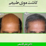 کلینیک کاشت مو طبیعی دکتر علی قاسمی در تهران