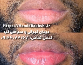 درمان سیاهی لب آقایان سیگاری