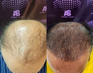 اسکالپ سر میکرواسکالپ در کرج علیرضا بهشتی پور