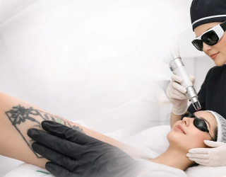 حذف تخصصی انواع تتو با لیزر در بندرانزلی 