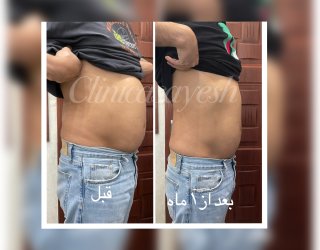 لاغری با کرایولیپولیز