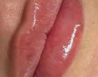 فیلر .بوتاکس. مزو .نخ
