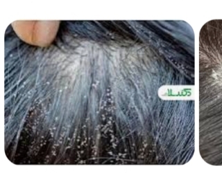 پاکسازی شپش سر