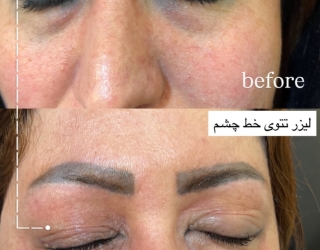 ریمو تتو بدنو صورت رفع تیرگی وایتنیگ 
