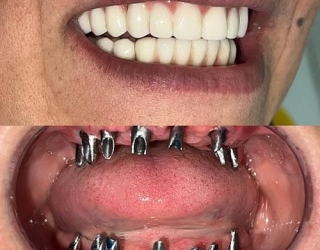 انجام ایمپلنت تخصصی