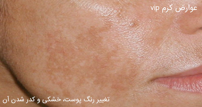 عوارض کرم vip