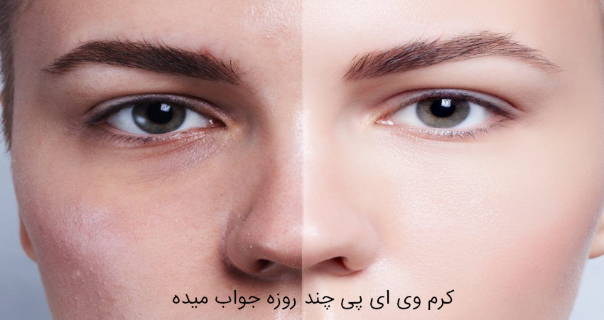 کرم وی ای پی چند روزه جواب میده